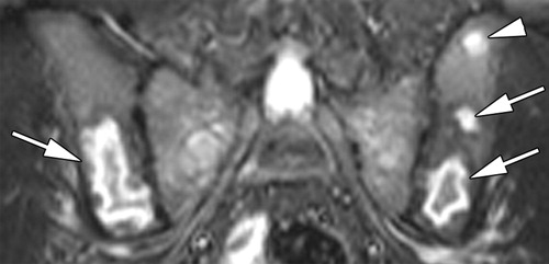 multiple myeloma beeld